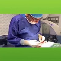 فیلم جراحی بلفاروپلاستی پلک بالا