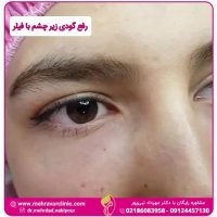 رفع گودی زیر چشم با تزریق فیلر