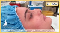 نمونه جراحی زیبایی بینی