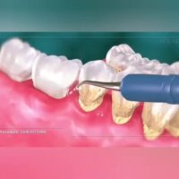 فیلم تمیزکاری عمیق و جرم گیری سطح ریشه دندان