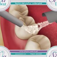 انیمیشن فیشور سیلانت | دندانپزشکی سیمادنت