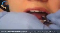 مراحل دیباند یا كندن براكت های ارتودنسی | دکتر داوودیان