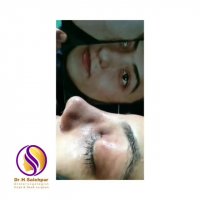 جراحی بینی گوشتی