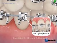 دکتر مسعود داودیان :: اجزاء دستگاه ارتودنسی ثابت