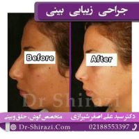 فیلم جراحی بینی