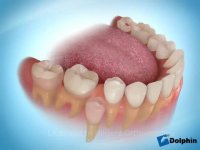 فضا نگهدار دندان شیری کودکان | دکتر مسعود داوودیان