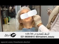 چند سال جوانتر با تزریق ژل خط خنده