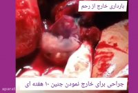 حاملگی خارج از رحم و جراحی برای خارج نمودن جنین 10 هفته ای