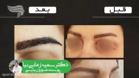 فیلم کاشت حرفه ای ابرو
