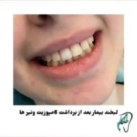 فیلم برداشت کامپوزیت ونیر