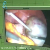 لاپاراسکوپی کیست آندومتریویید