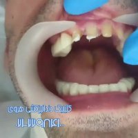 لمینت دندان ها چه تاثیری در زیبایی افراد دارد؟