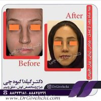 صحبت های بیمار 3 ماه بعد از عمل جراحی بینی