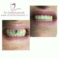 💥ونیر کامپوزیت همراه با ترمیم پوسیدگی💥