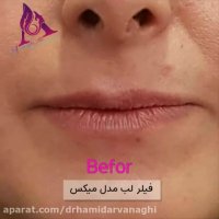 فیلم نمونه فیلر لب مدل میکس