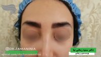 فیلم نتیجه قبل و بعد کاشت ابرو