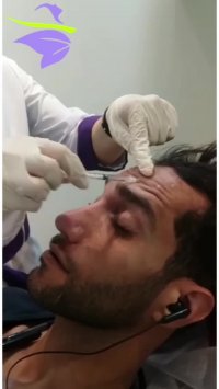 فیلم واقعی تزریق بوتاکس