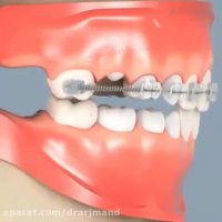 زود کشیدن دندان شیری