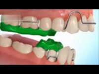 جلو آوردن فک پایین با دستگاه 