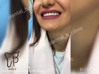 کامپوزیت دندان