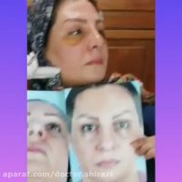 فیلم واقعی از عمل بینی گوشتی