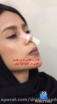 چسب زدن بینی