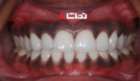 چرا لثه سیاه می شود؟