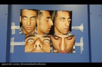 جراحی بینی استخوانی قوزدار انحراف دار توسط دکتر امید ابراهیمی