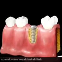 ایمپلنت دندان و نصب تاج