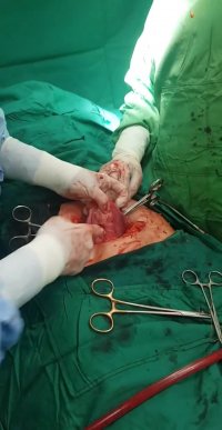 میوم بعد از خارج کردن فیبرم