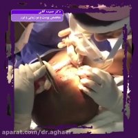 فیلم کاشت مو