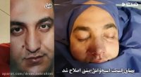 عمل بینب گوشتی کج توسط دکتر امید ابراهیمی بهترین جراح بینی در تهران