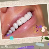 یک هفته بعد از انجام ونیر کامپوزیت