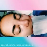 جراحی زیبایی بینی با پروجکشن کم و افتادگی زیاد