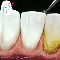 آیا شما به جرمگیری دندان احتیاج دارید؟