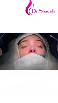 بلافاصله بعداز جراحی بینی