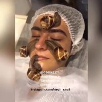 حلزون تراپی