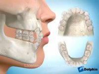 دکتر مسعود داودیان :: کشیدن دندان در ارتودنسی