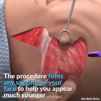 جراحی لیفت صورت