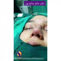 جراحی بینی گوشتی