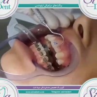 براکت سرامیکی | دندانپزشکی سیمادنت
