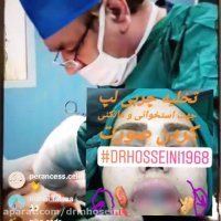 تخلیه چربی بوکال جهت استخوانی شدن صورت