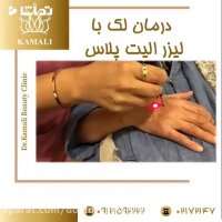 درمان لک با لیزر الیت پلاس