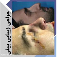 عمل بینی توسط دکتر حمید رضا فتحی