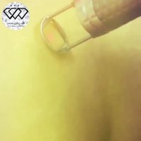 فیلم واقعی درمان استریا با لیزر فوتونا (ترک های ناشی از چاقی و لاغری مکرر)