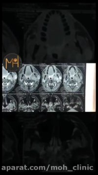 جراحی عود وسیع تومور پاروتید