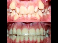 عکس های قبل و بعد ارتودنسی | دکتر مسعود داودیان