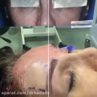 لیفت اندوسکوپیک پیشانیتوسط دکتر شهریار حدادی راه های ارتباطی دکتر ...