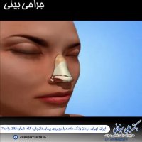 جراحی بینی