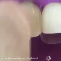 لمینت دندان-دکترمجیدقیاسی دندانپزشک زیبایی مشهد